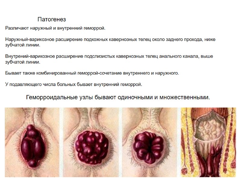 Патогенез  Различают наружный и внутренний геморрой.  Наружный-варикозное расширение подкожных кавернозных телец около